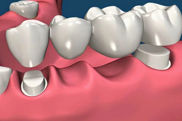 Bị tiêu xương có cấy nghép Implant được không?